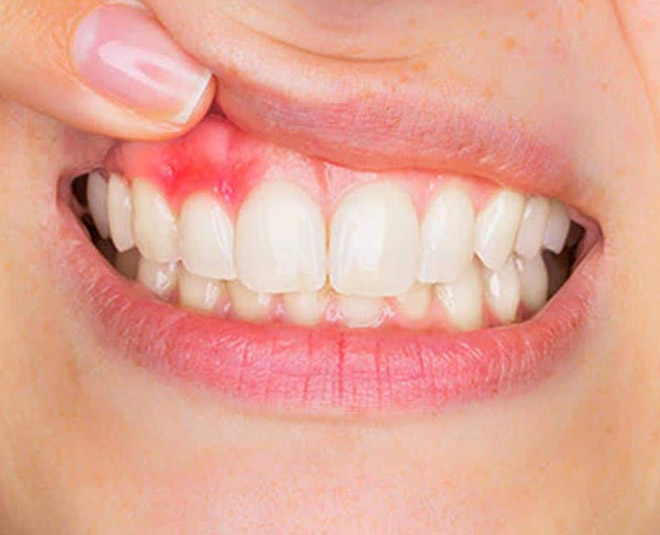 ayurveda tips for receding gum inside