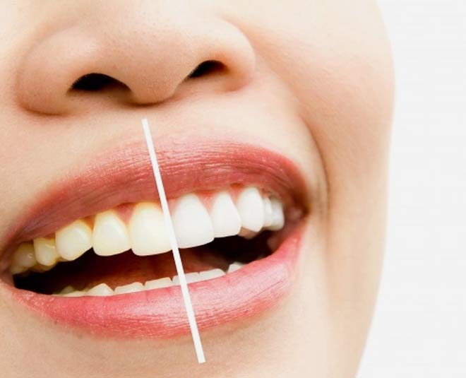 yellow teeth apple cider vineger