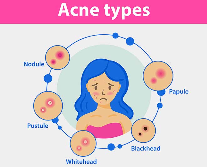 types of acne