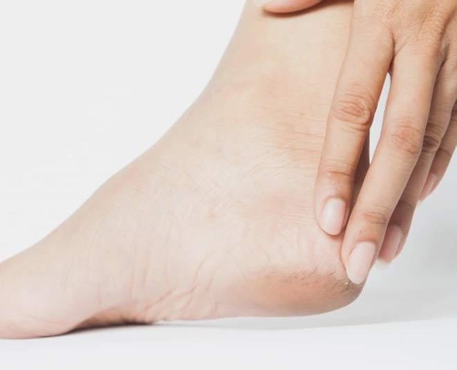 how to treat cracked heels