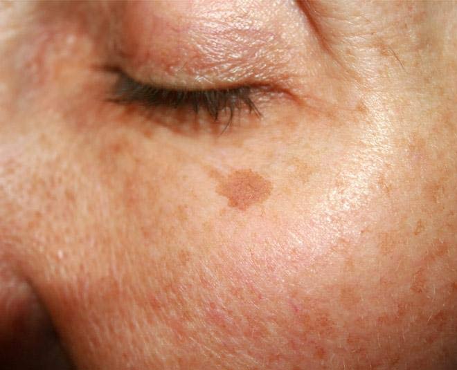 ageing liver spots
