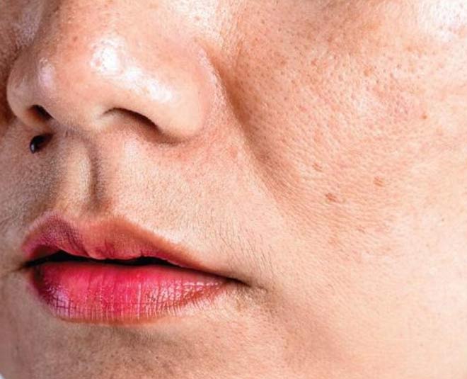 fatty liver skin problems