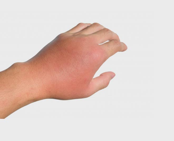 pattharchatta for inflammation