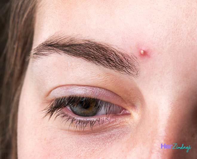 heat boils on the face