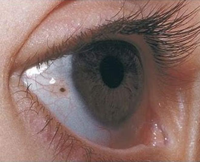 what does mole on eyes indicate