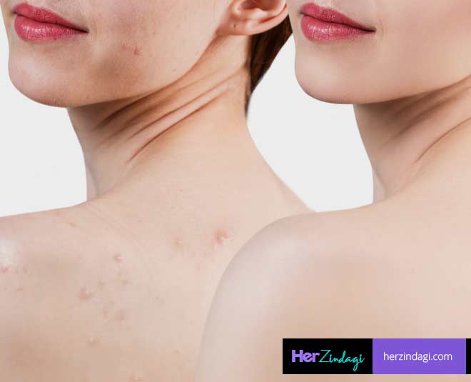 back and tanning pimples