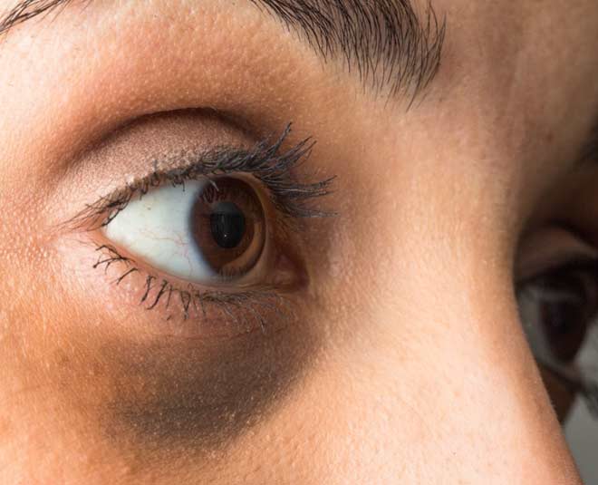 dark circles and issues reasons