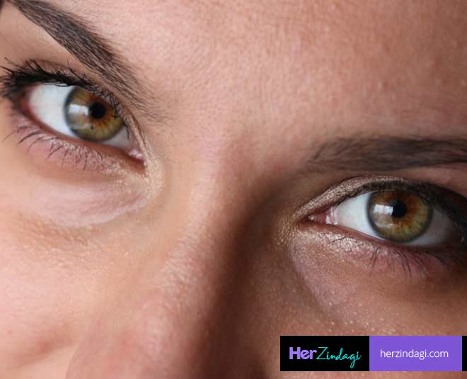 dark circles and their issues