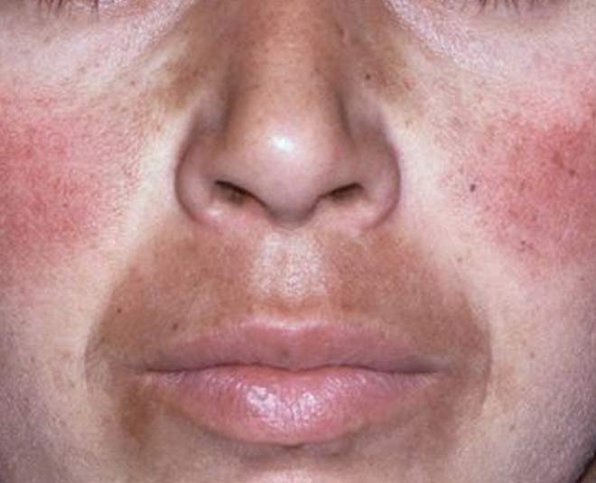 face and dark spots in hindi