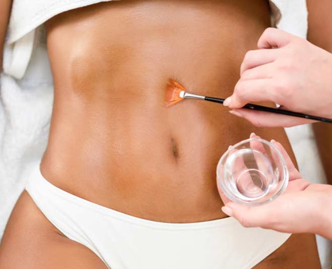 stretch marks treatment at home