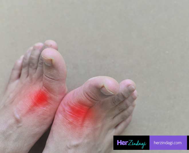 uric acid symptoms