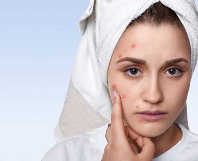 ginger for acne inside