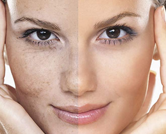 inside hyperpigmentation