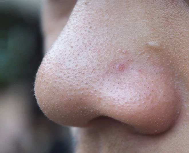 skin texture and blackheads