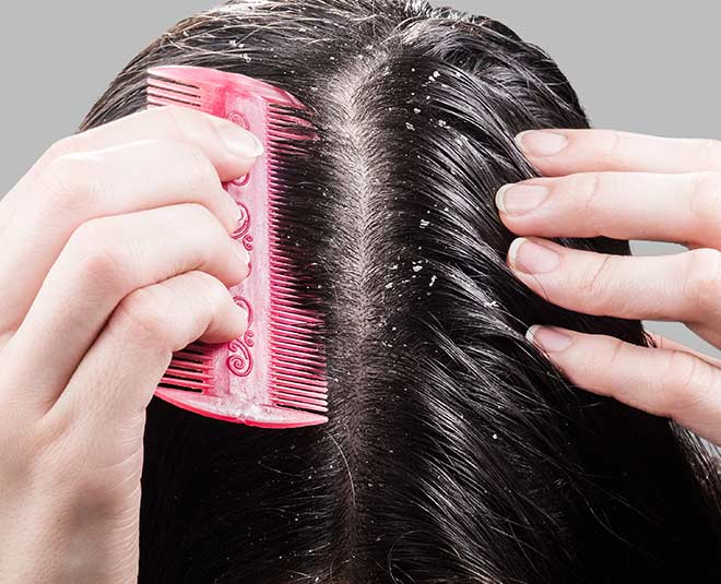 dandruff and its problesm