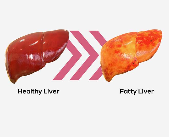 fatty liver and issues
