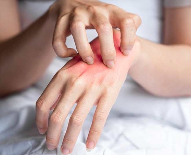 chiggers  bite  home  remedies