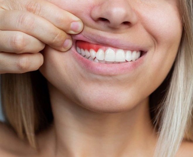 symptoms of periodontaitis