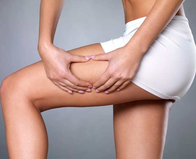 what is stretch marks