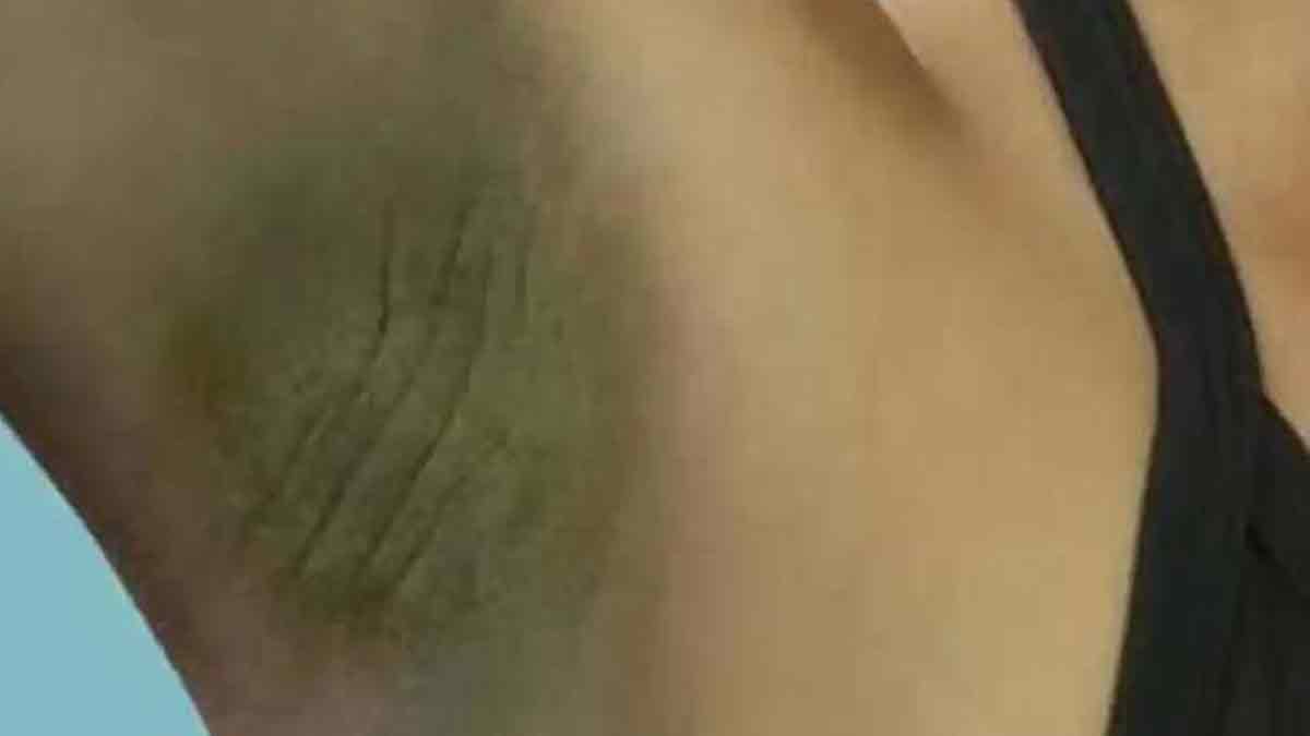 dark underarms and body odor