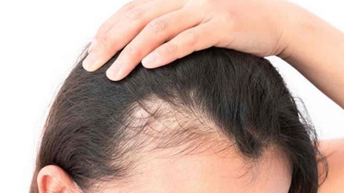 hair fall and bald spots