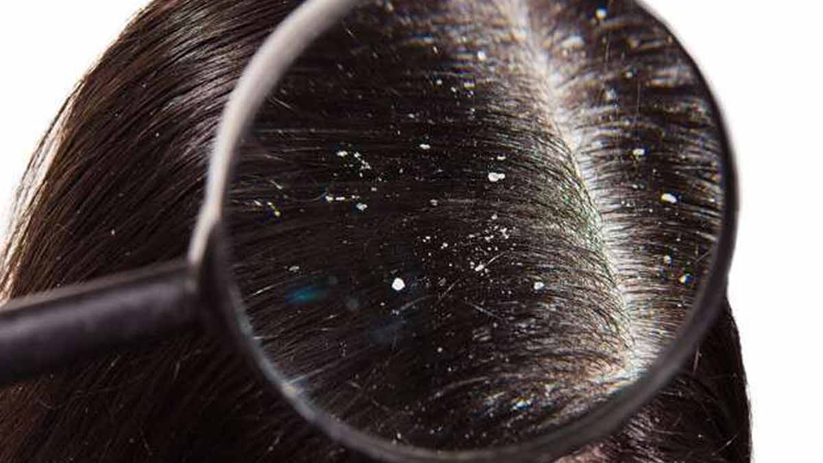 dandruff problems and  nuskhe