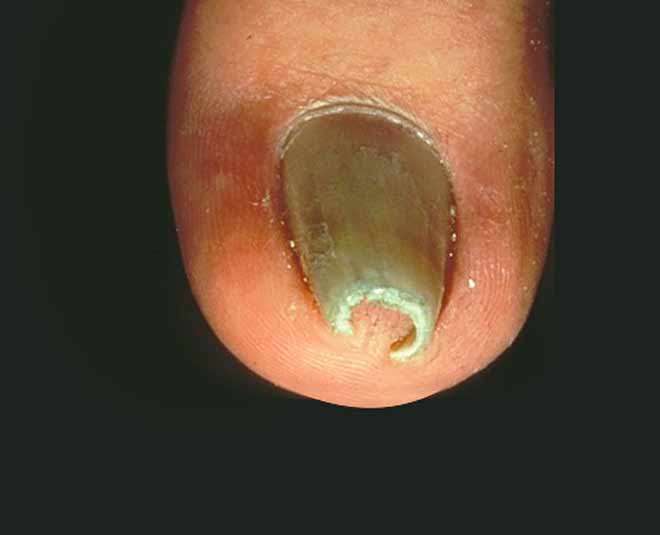 nails ingrown and outgrown