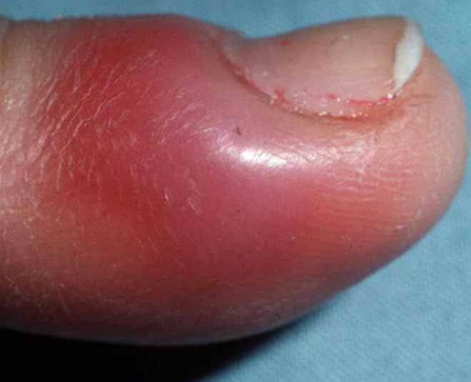 nails swelling on nail bed
