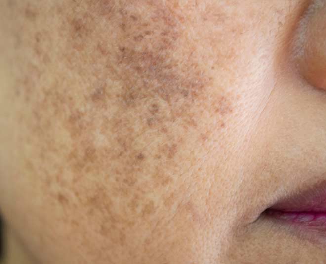 dark spots face pack