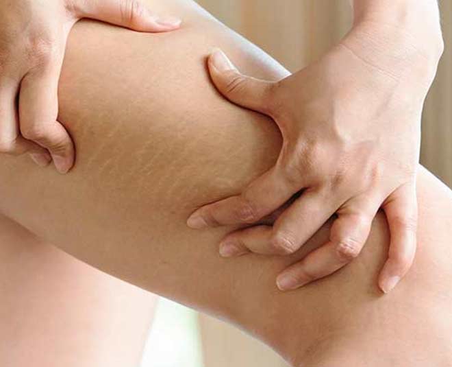 skin stretchmarks