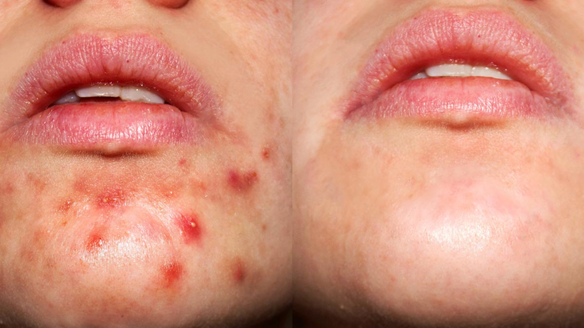 Remove Blackness Around Chin Area