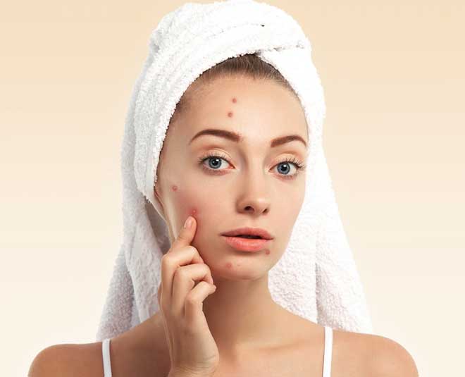 acne scars