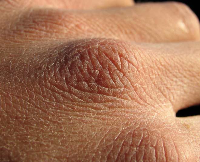 dry hands due to chores