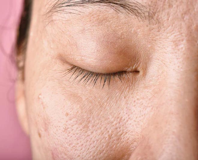 open pores best cream