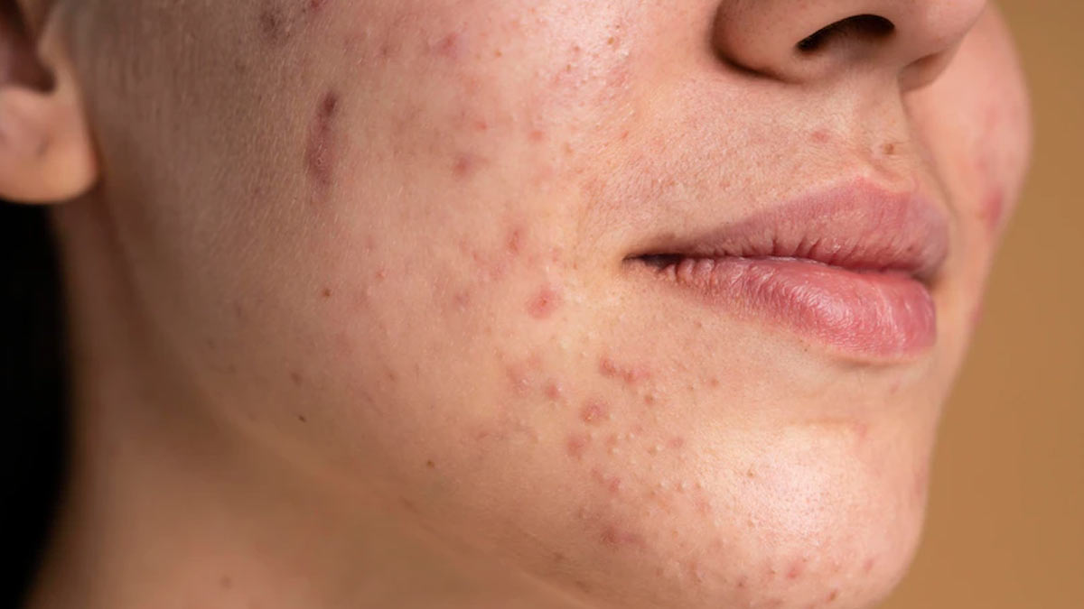 acne and harmonal issues