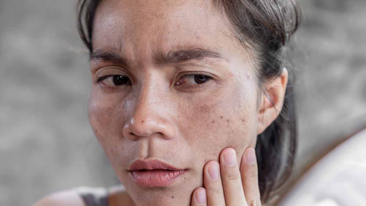 coconut oil and its related skin issues