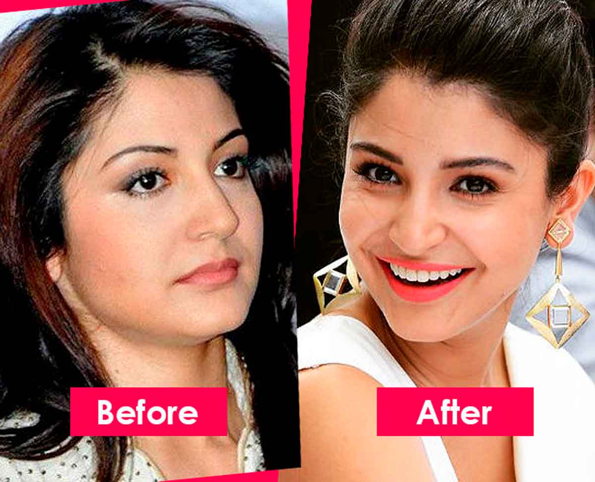 anushka sharma lip fillers
