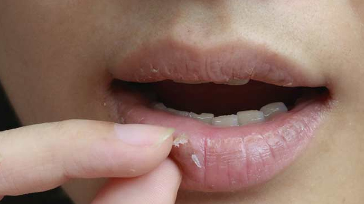 cracked lips