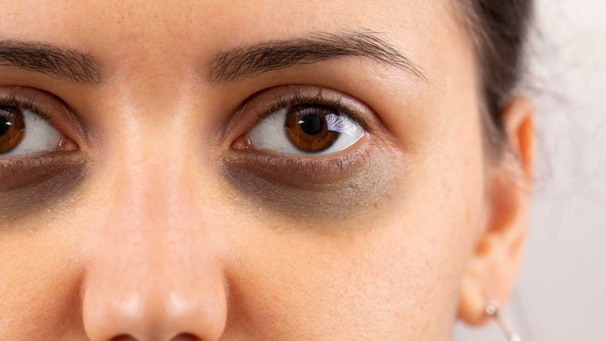 dark circles problem