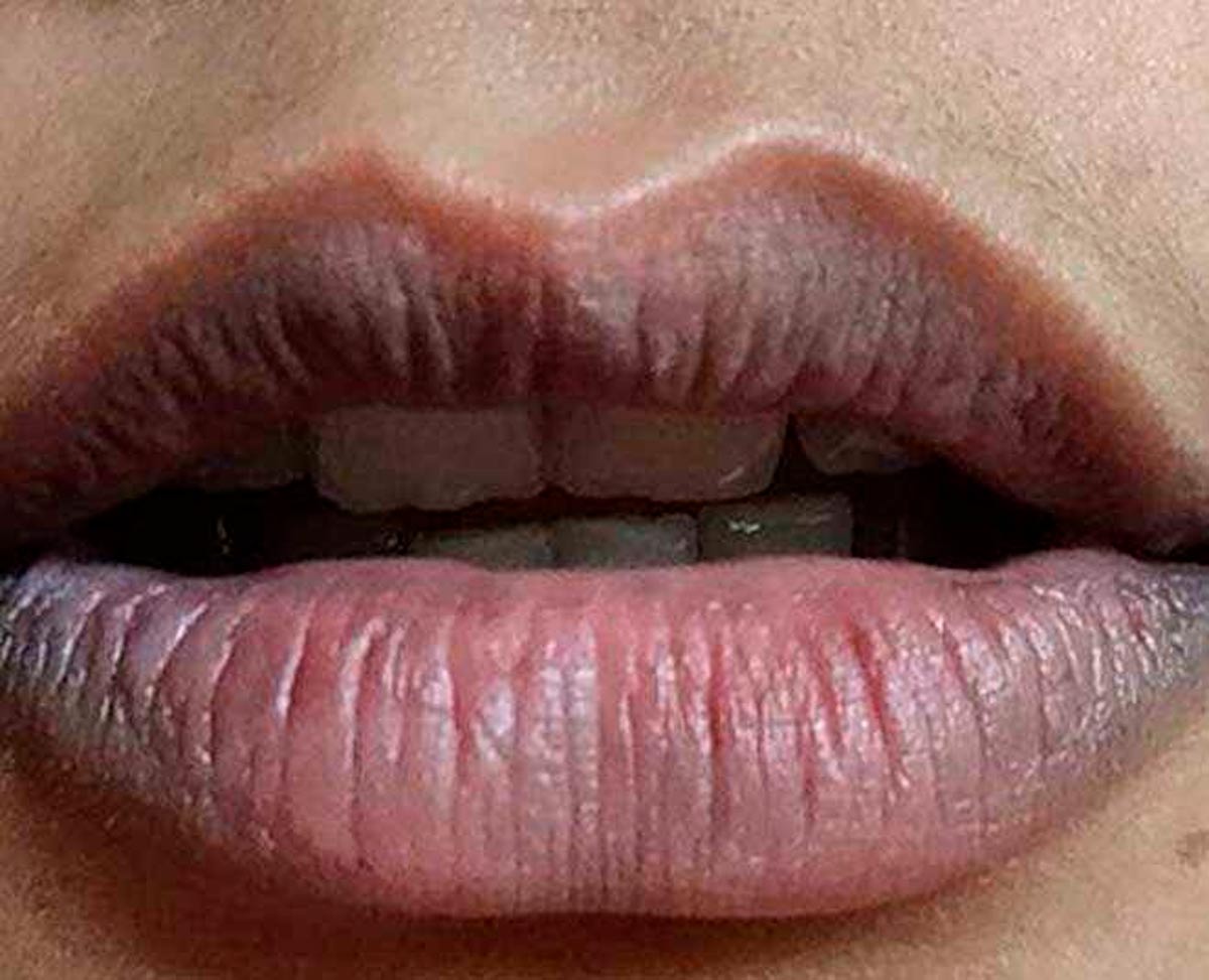 dark lips issues and its problems