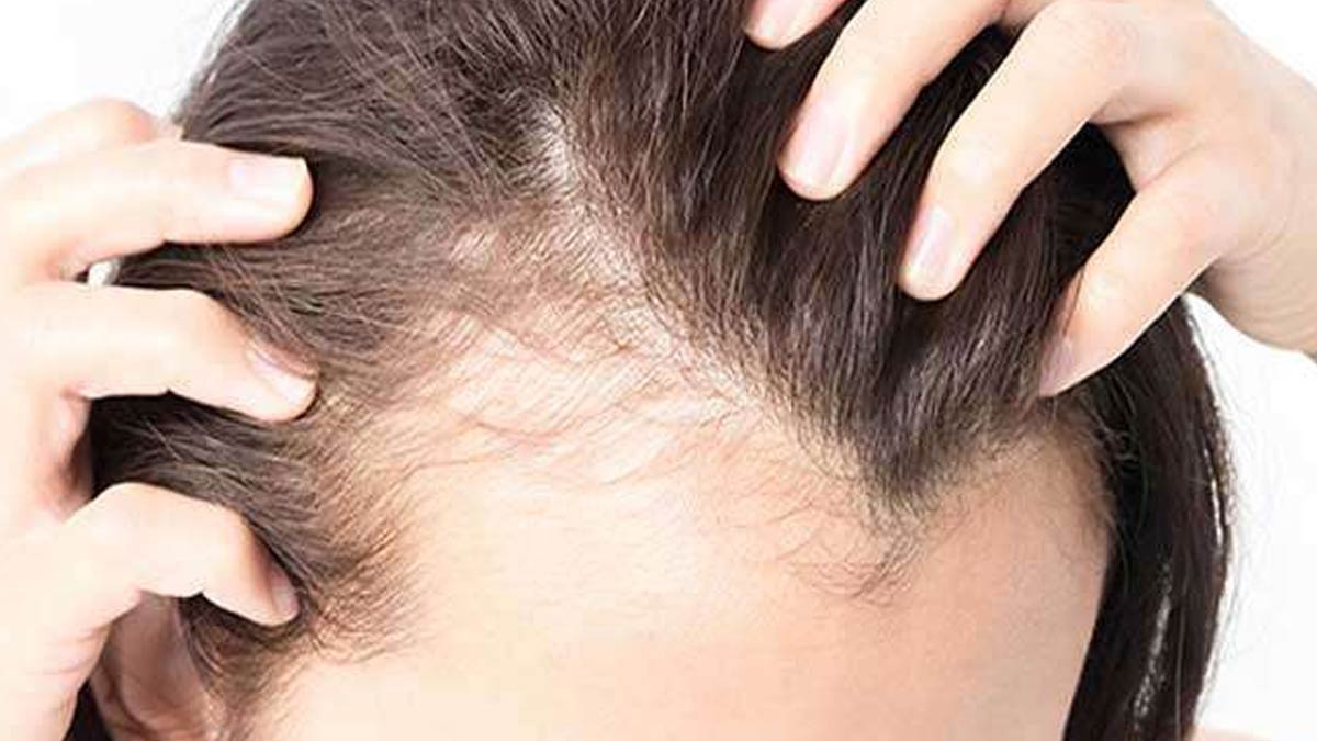 hairfall and its problems