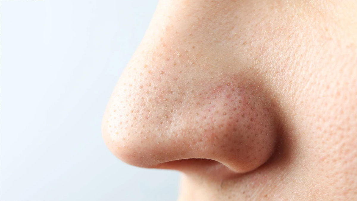nose pores