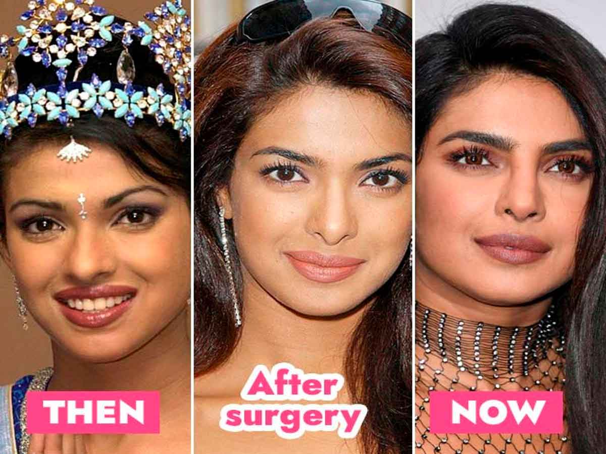 priyanka chopra lip surgery