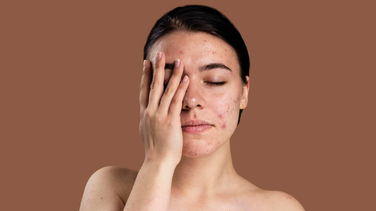 Exfoliation For Acne Prone Skin