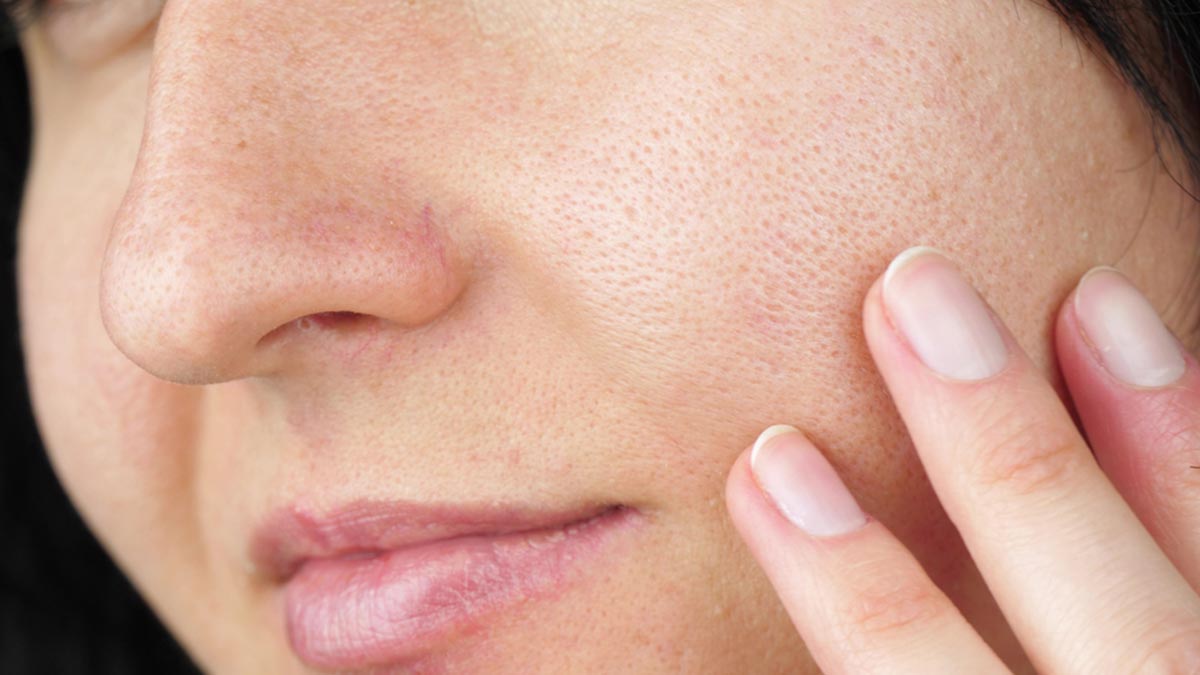 Exfoliation On Pores