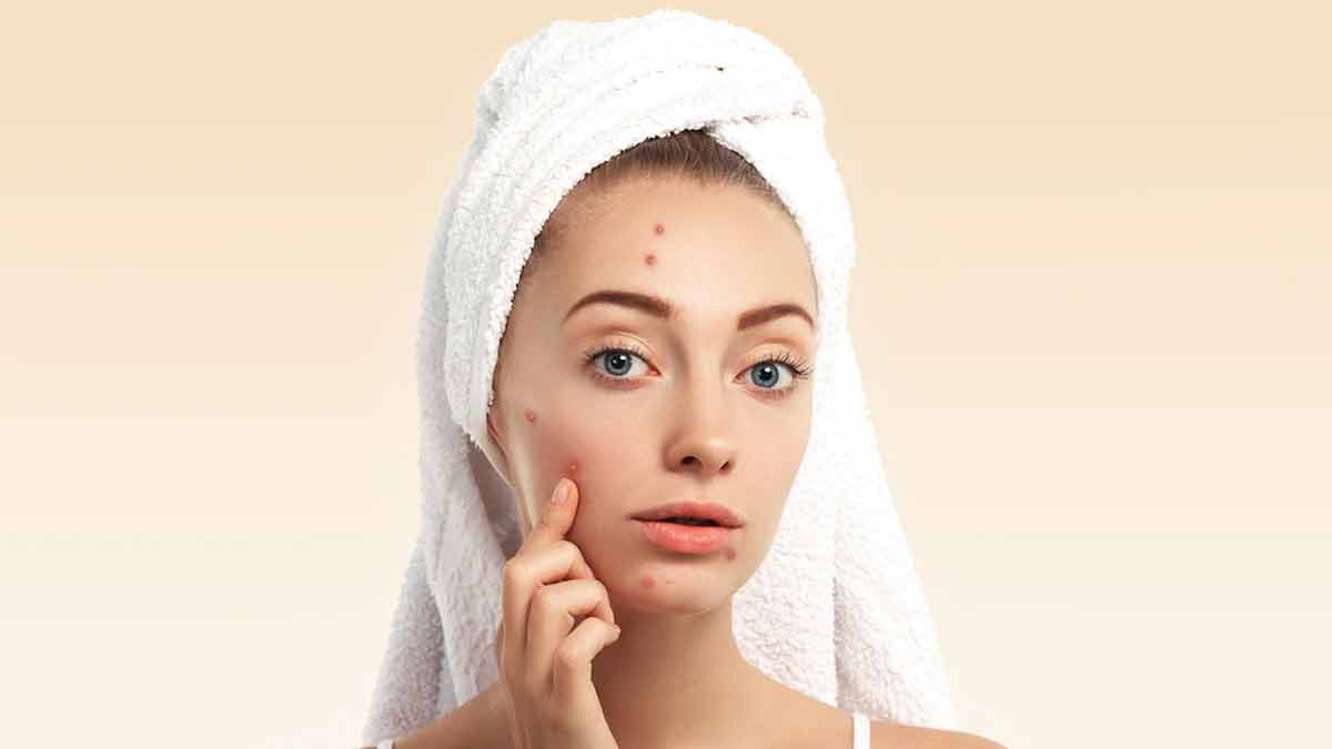 acne ke liye face mask
