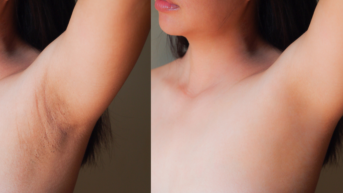 How To Do Underarm Brightening