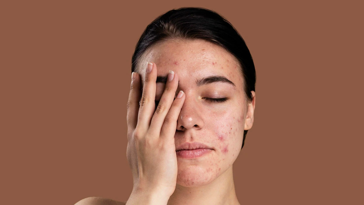 can hormonal imbalance cause dandruff