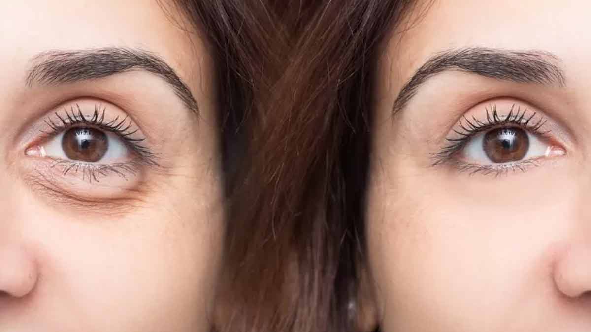 eyebags and its issues