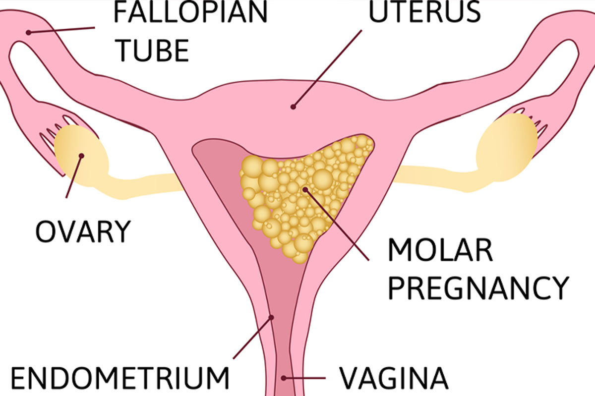 molar pregnancy